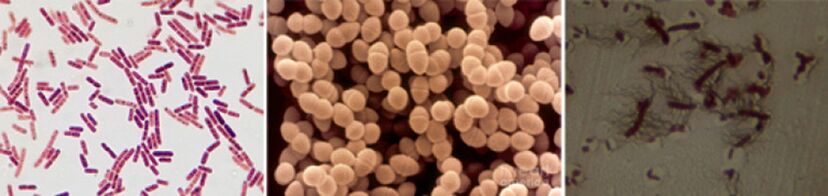 E. coli, enterococcus fecal y proteus son los principales agentes causantes de la prostatitis bacteriana crónica