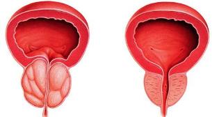 la diferencia enfermo y saludable de la próstata