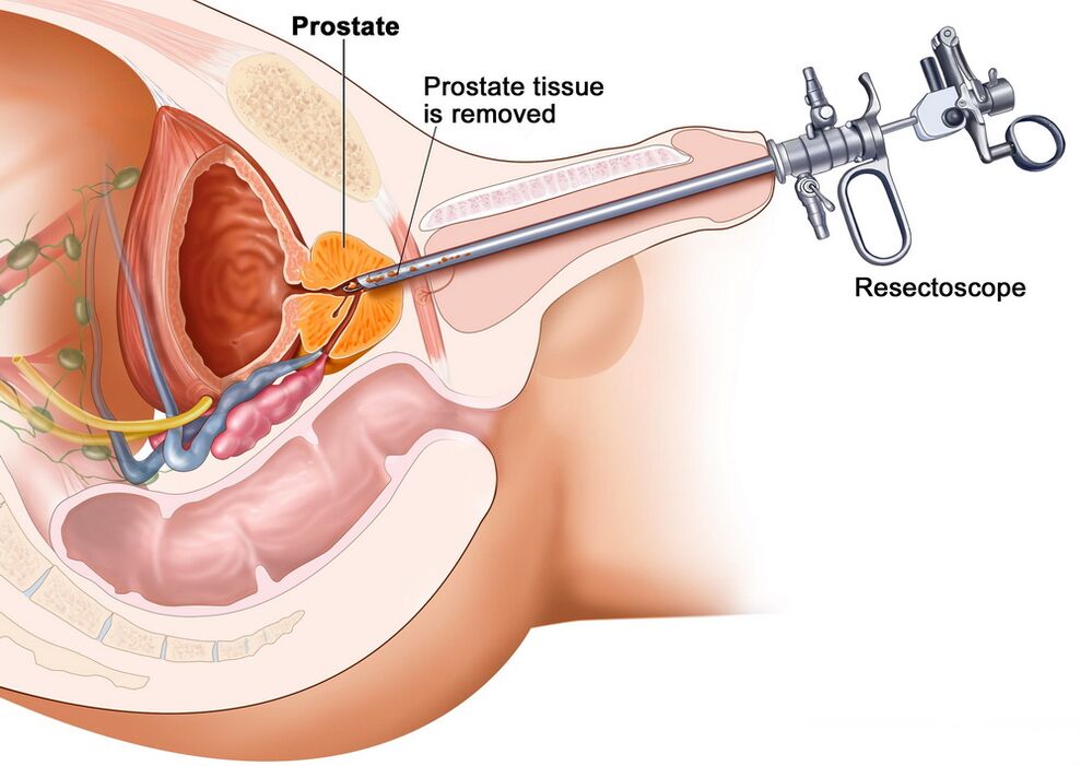 Recolección de tejido prostático para un diagnóstico preciso de prostatitis