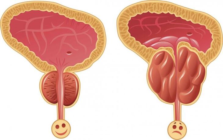 Prostata y prostatitis saludables